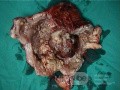 Mixed Mullerian Tumour Of The Uterus