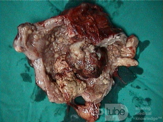 Mixed Mullerian Tumour Of The Uterus