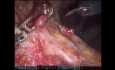 Robotic e-TEP Ventral Hernia Repair