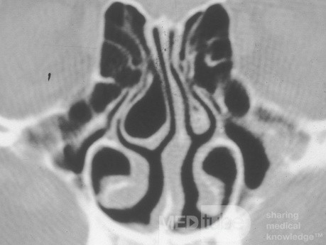 Vasoconstrictionof the Inferior Turbinates [CT scan]
