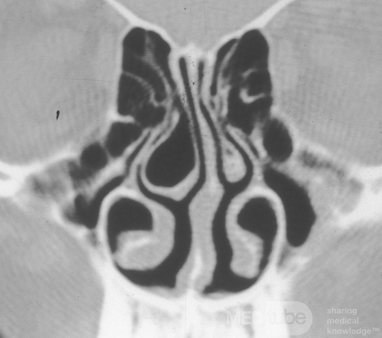Vasoconstrictionof the Inferior Turbinates [CT scan]