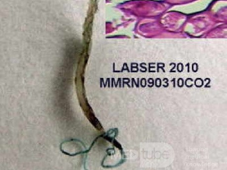 Trichuris Trichuris (whipworm) (6 of 10)