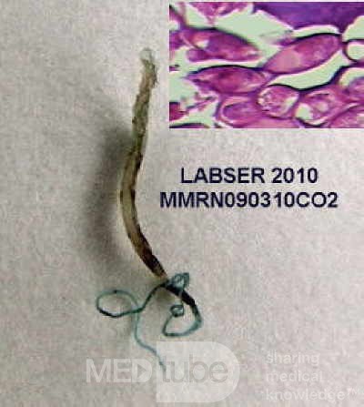 Trichuris Trichuris (whipworm) (6 of 10)