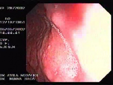 Zollinger- Ellison Syndrome - Gastric Ulcer with Gastrocolic Fistula (14 of 21)