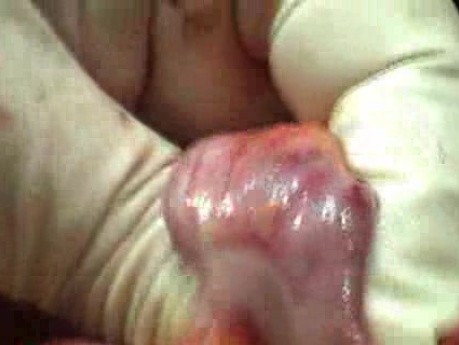 Adenocarcinoma Of The Transverse Colon - Endoscopy (3 of 9)