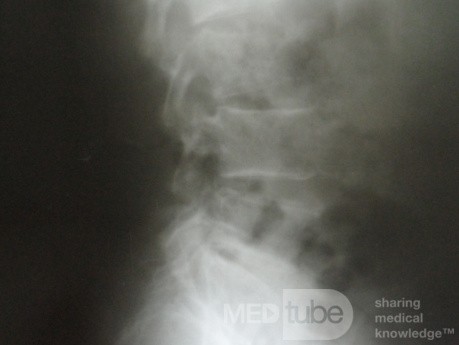 Lumber mets from pancreatic cystadenocarcinoma 