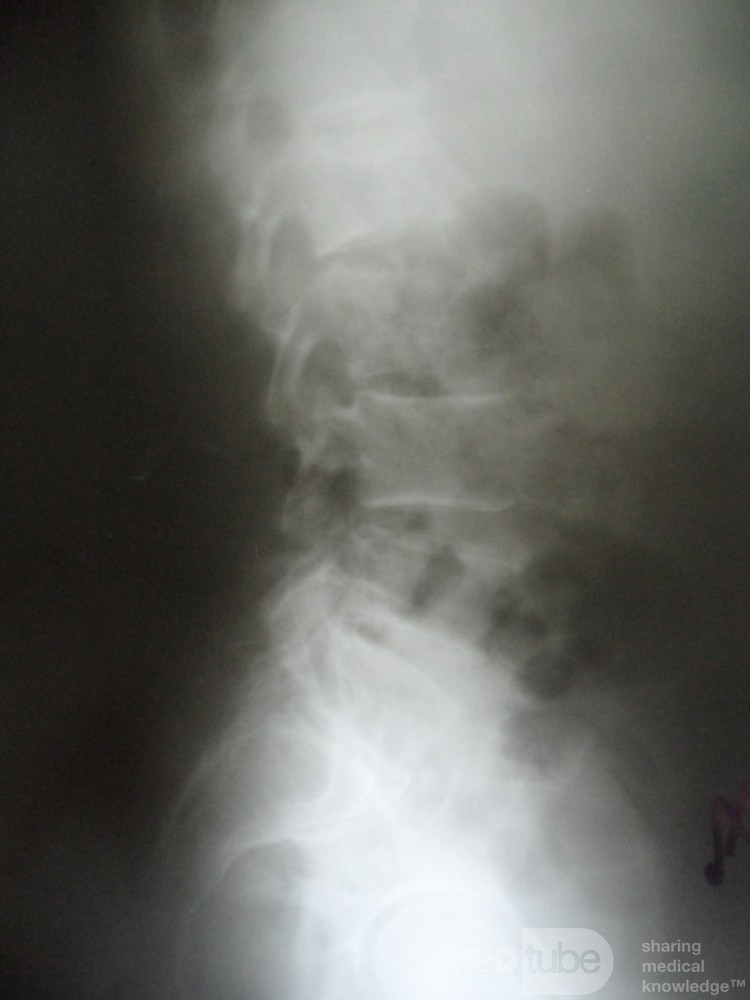 Lumber mets from pancreatic cystadenocarcinoma 