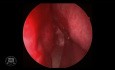 Pituitary Adenoma Endoscopic Resection