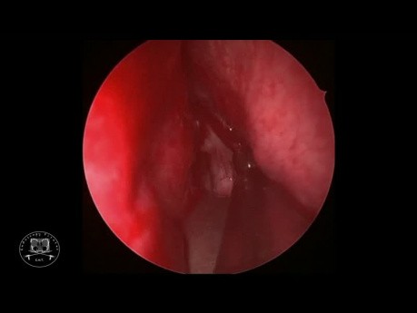 Pituitary Adenoma Endoscopic Resection