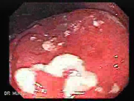 Non-Hodgkin B-Cell Lymphoma - Assessment of the Lesions, Part 1