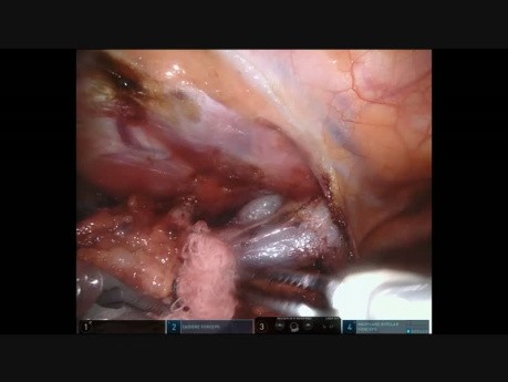 Robotic Thymectomy