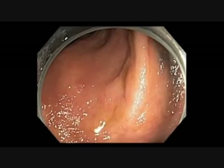 EMR ScarA