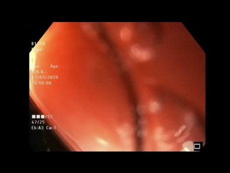 Corkscrew Esophagus