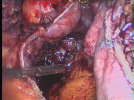 Conversion of VBG to Sleeve Gastrectomy