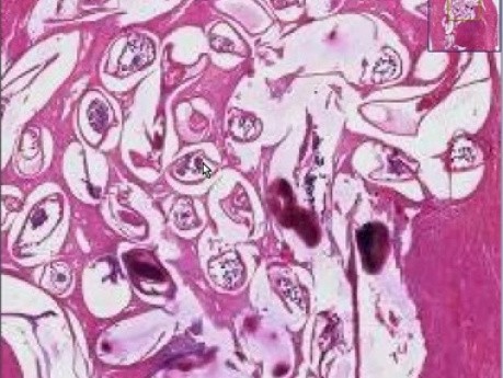 Filariasis