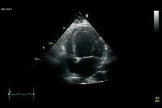Dilated Cardiomyopathy - DCM