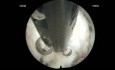 L5 Left Highly Down Migrated Disc