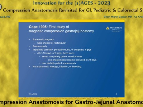 Compression Anastomosis for Gastro-Jejunal Anastomosis