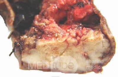 Gallbladder Adenocarcinoma and litiasis (5 of 13)