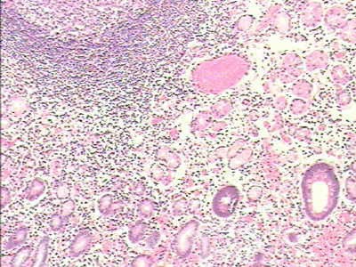 Adenocarcinoma of the cardias and gastric fundus with signet-ring cells (18 of 25)
