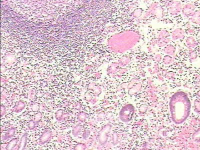 Adenocarcinoma of the cardias and gastric fundus with signet-ring cells (18 of 25)