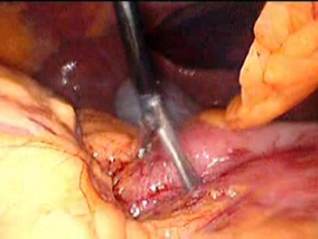 Gastrointestinal Stromal Tumor - GIST (12 of 65)