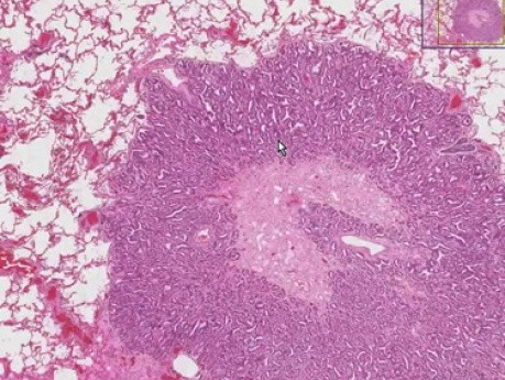 Metastatic adenocarcinoma - Histopathology - Lung