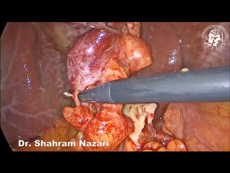 Gangrenous Cholecystitis