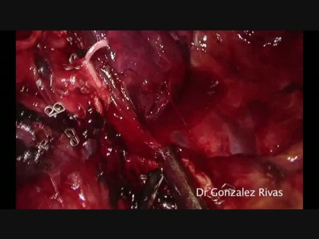 Subxiphoid Uniportal VATS Right Upper Lobectomy