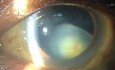 Subluxation of Lens 