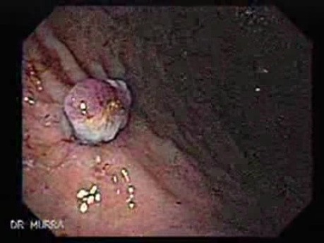 Dieulafoy´s Lesion (Exulceratio Simplex) (7 of 9)