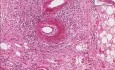 Polyarteritis - Adrenal gland - Histopathology