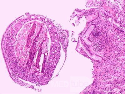 Ovarian Carcinoma Metastatic to Stomach and Duodenum (17 of 20)