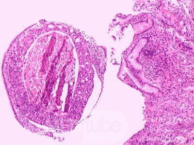 Ovarian Carcinoma Metastatic to Stomach and Duodenum (17 of 20)