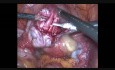 Laparoscopic Management of Ovarian Dermoid Cyst