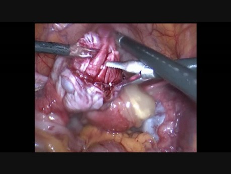 Laparoscopic Management of Ovarian Dermoid Cyst