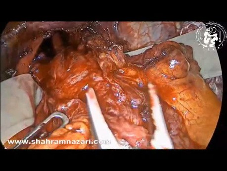 Mucosal Perforation During Laparoscopic Heller Myotomy Suture and Fat Pad Treatment