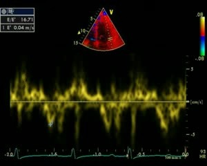Cardiomyopathy Restrictive