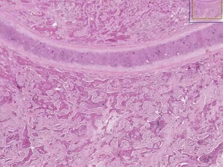 Squamous cell carcinoma - Histopathology - Lung, esophagus