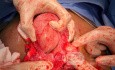 Abdominal Myomectomy