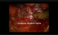 Robotic APR - Modification of ELAPE Technique