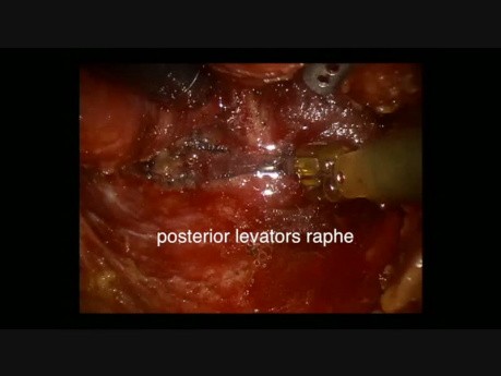 Robotic APR - Modification of ELAPE Technique