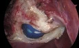 Large Fibroid Uterus - Total Laparoscopic Hysterectomy