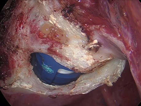 Large Fibroid Uterus - Total Laparoscopic Hysterectomy
