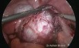 Large Ovarian Cyst - Laparoscopic Surgery