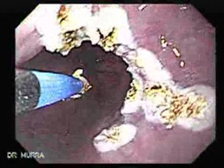 Barrett's Esophagus of long segment (7 of 11)