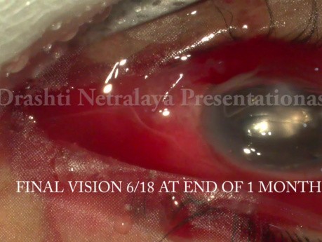 Management of Traumatic Endophthelmitis