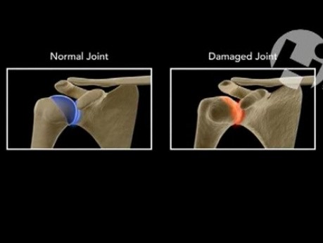 Chondrolysis of the Shoulder Joint