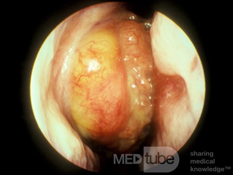 Inverting Papilloma Nasal Cavity