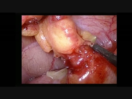 Laparoscopic Appendectomy in Situs Inversus